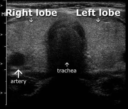 Thyroid ultrasound